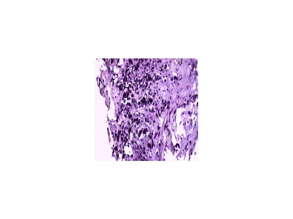Breast cancer metastatic to the pituitary gland: a case ...