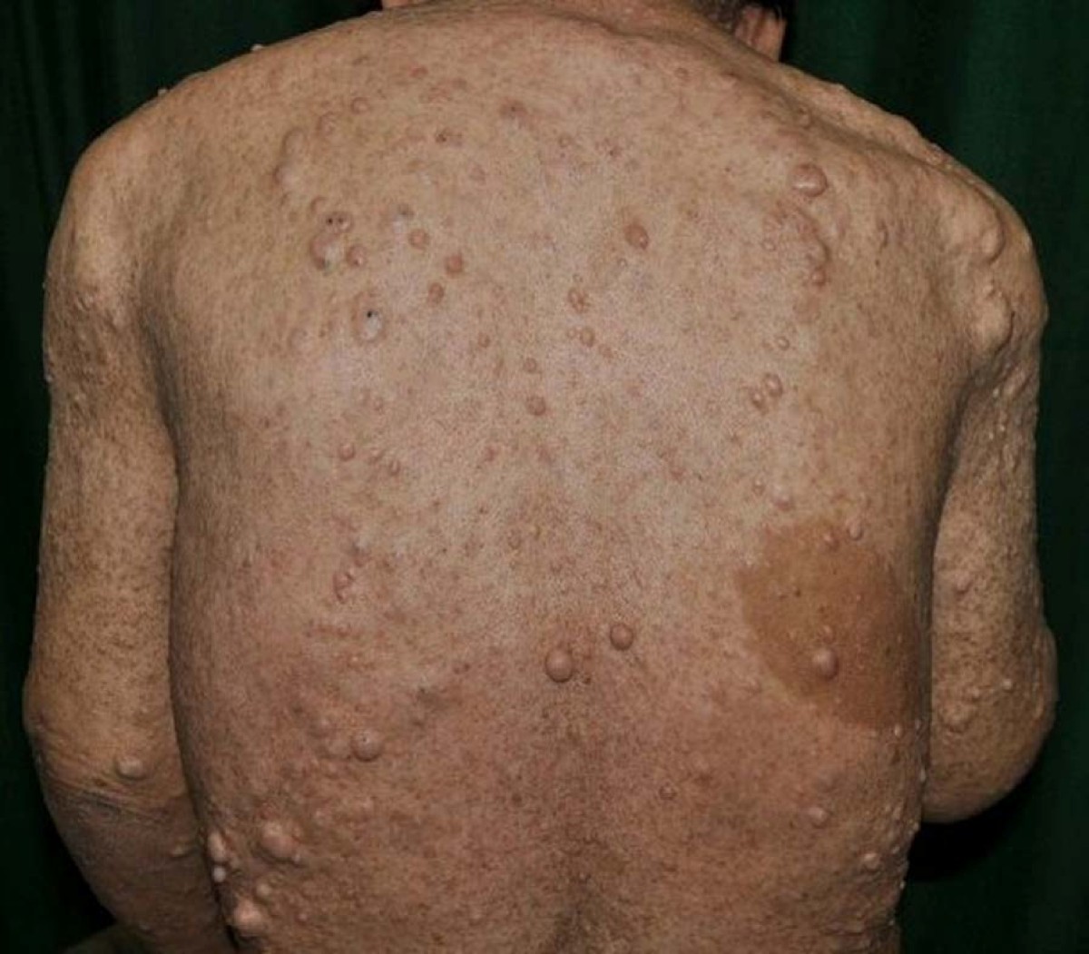 A Case Of Pancreatic Neuroendocrine Tumor In A Patient With A Case Of Pancreatic Neuroendocrine Tumor In A Patient With