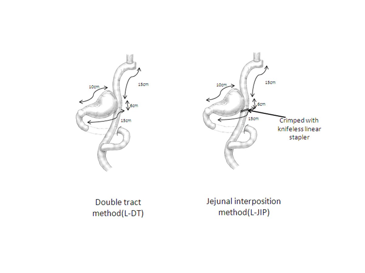 Functional by reconstruction technique following laparoscopic