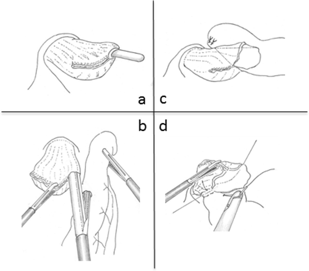 The overlap method is a safe and feasible for esophagojejunostomy after