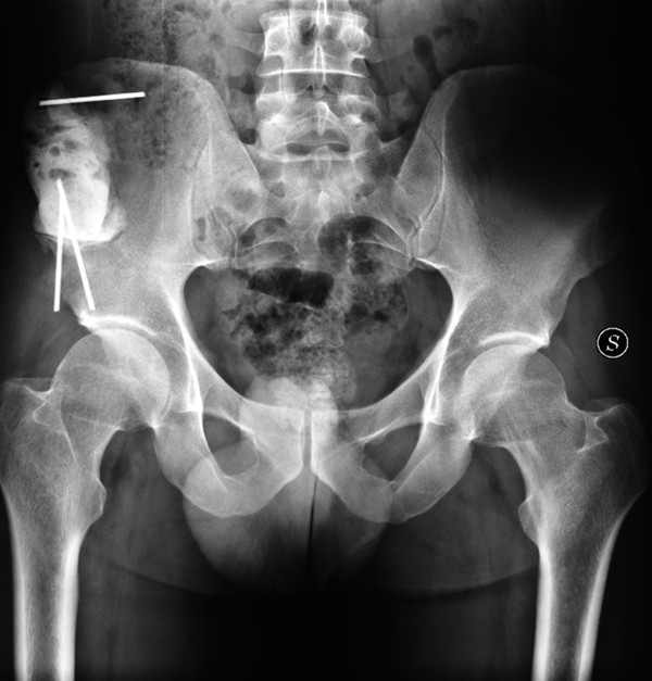 A rare case of iliac crest metastasis from acinic cell carcinoma of
