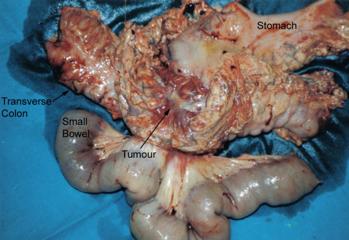 Long-term survival from gastrocolic fistula secondary to adenocarcinoma