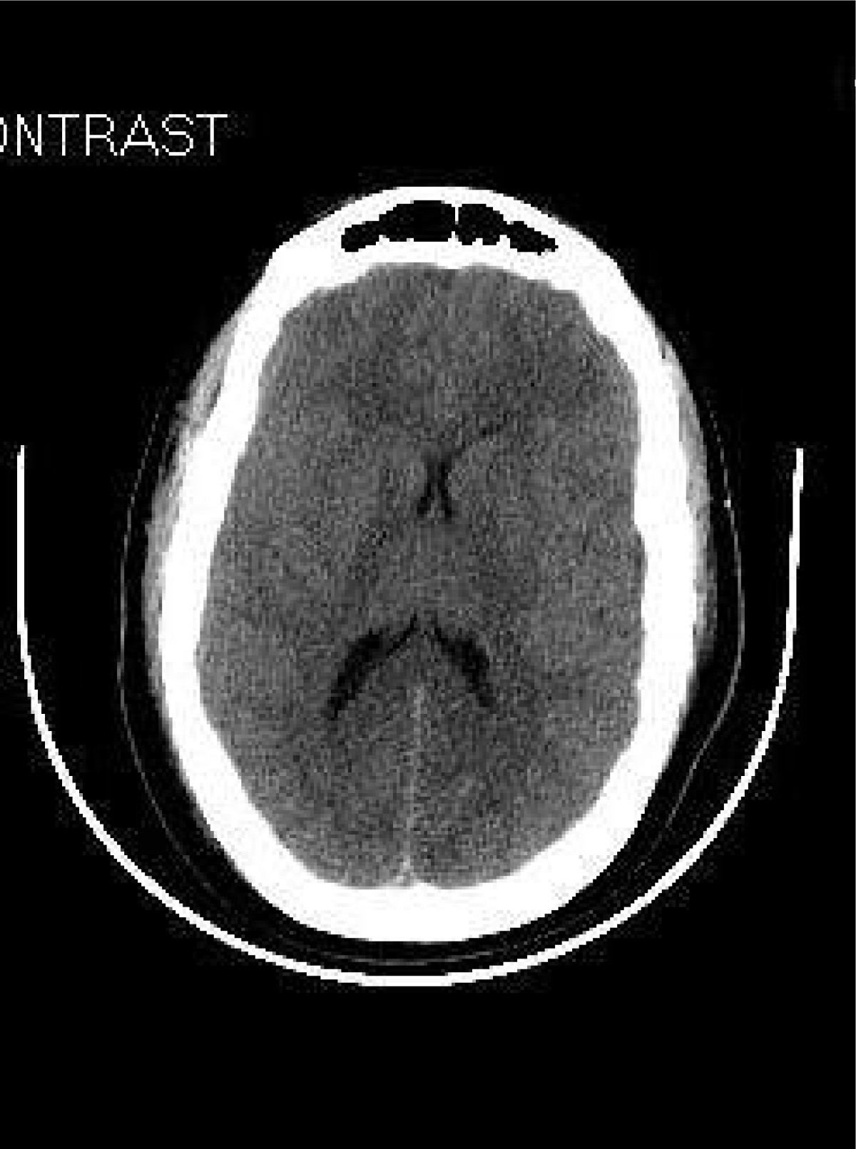 Cerebral edema in a patient following cytoreductive surgery and