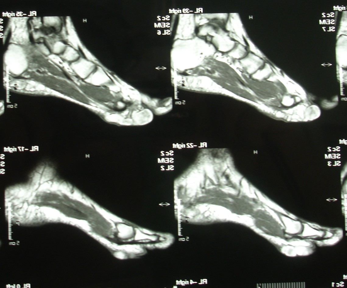 Forefoot plantar multilobular noninfiltrating angiolipoma a case