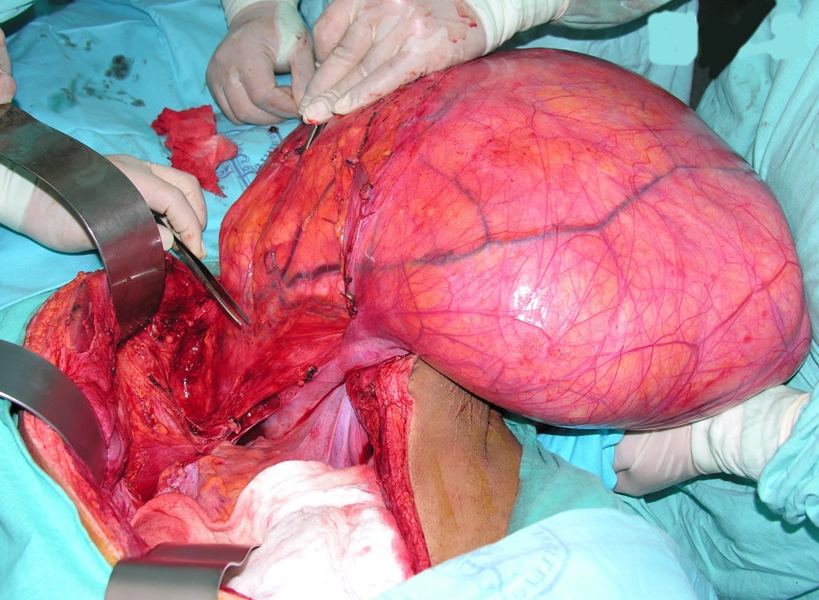 Giant retroperitoneal World Journal of