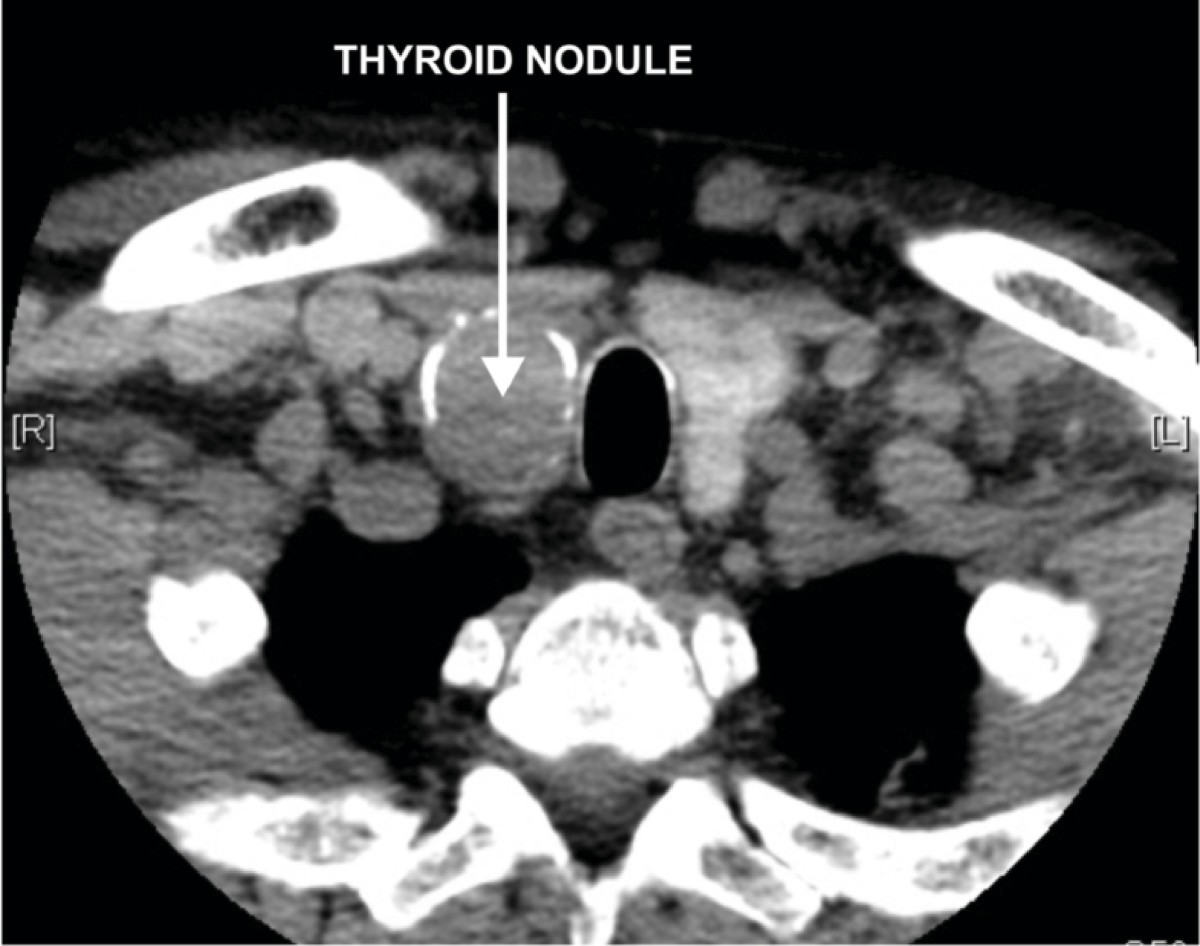Metastatic colorectal cancer to a primary thyroid cancer | World