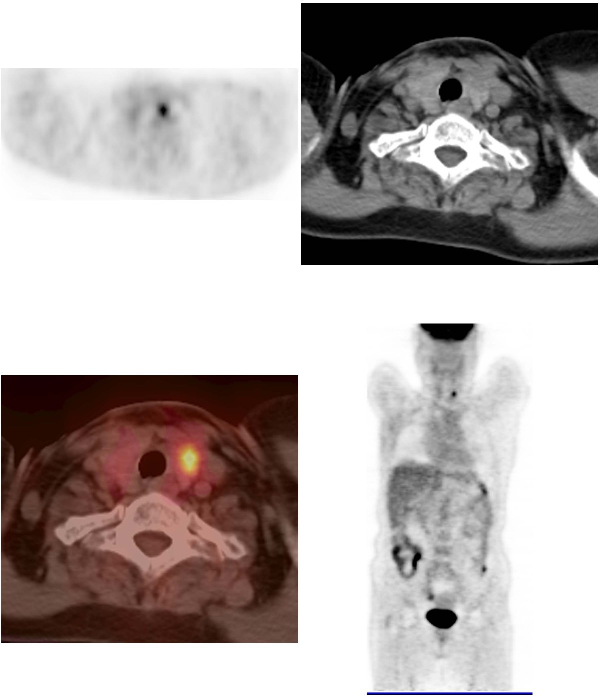 Incidental thyroid lesions detected by FDGPET/CT prevalence and risk