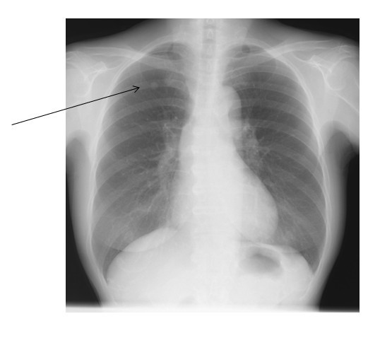 Adenoid cystic carcinoma of the peripheral lung: a case report | World ...