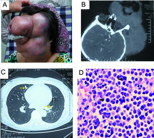 Giant Merkel cell carcinoma of the eyelid: a case report ...