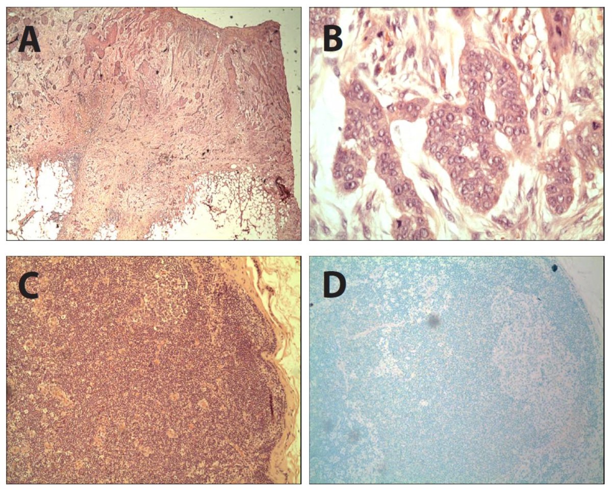 sentinel lymph node biopsy for squamous cell carcinoma sentinel lymph node biopsy for squamous cell carcinoma