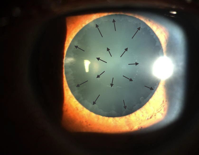 Pseudoexfoliation syndrome, a systemic disorder with ocular