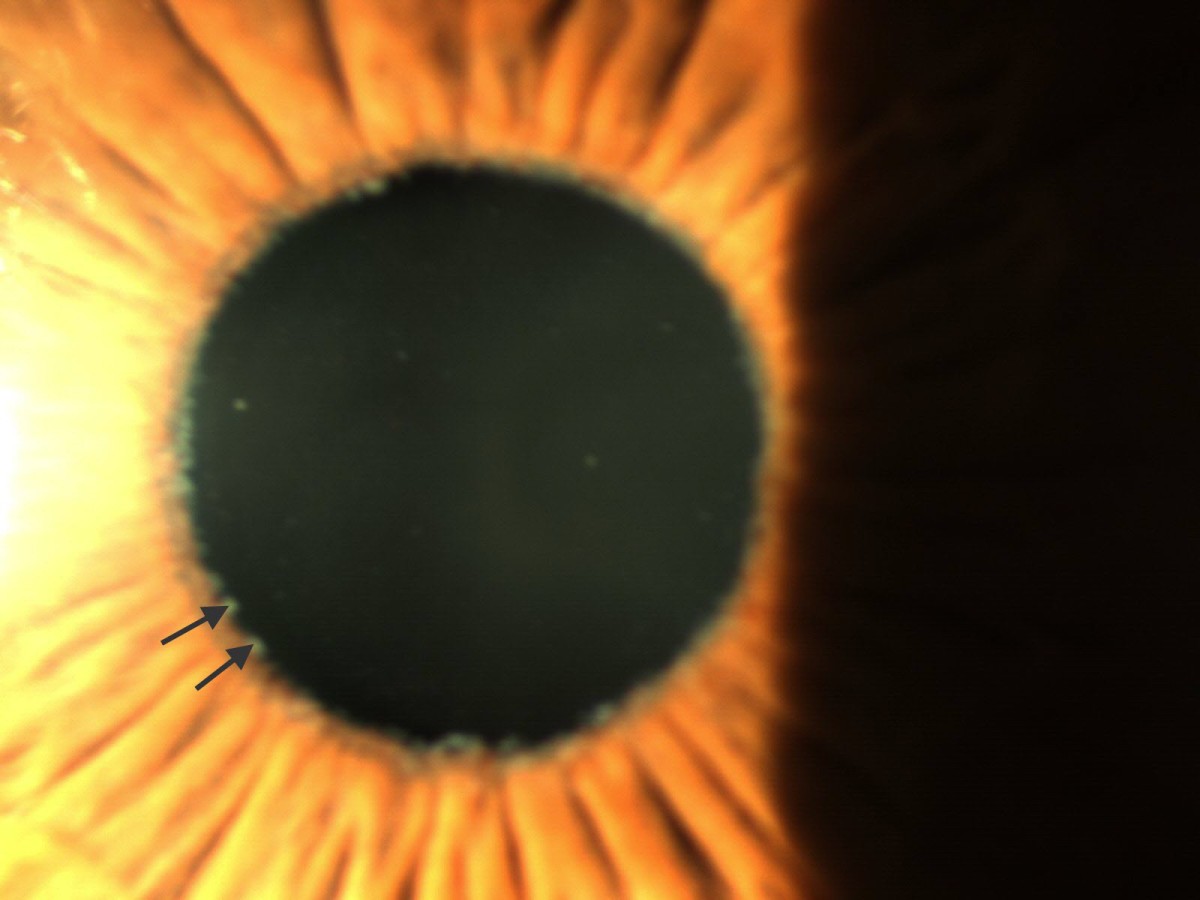 Pseudoexfoliation syndrome, a systemic disorder with ocular