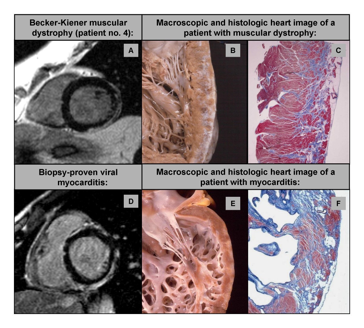 Cardiac involvement in patients with Becker muscular dystrophy new