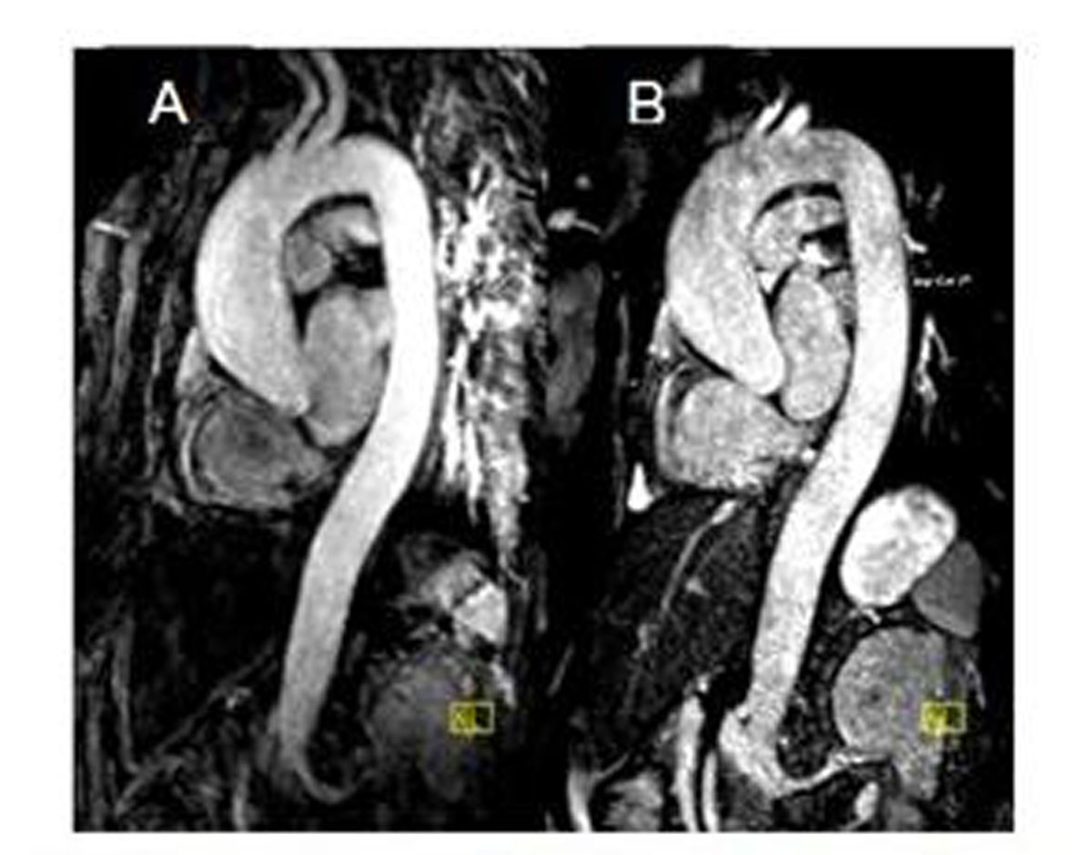 Single breathhold noncontrast thoracic mra using highlyaccelerated