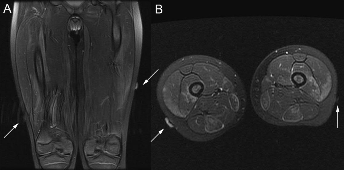 MRI guided wire localization muscle biopsy in a child with juvenile