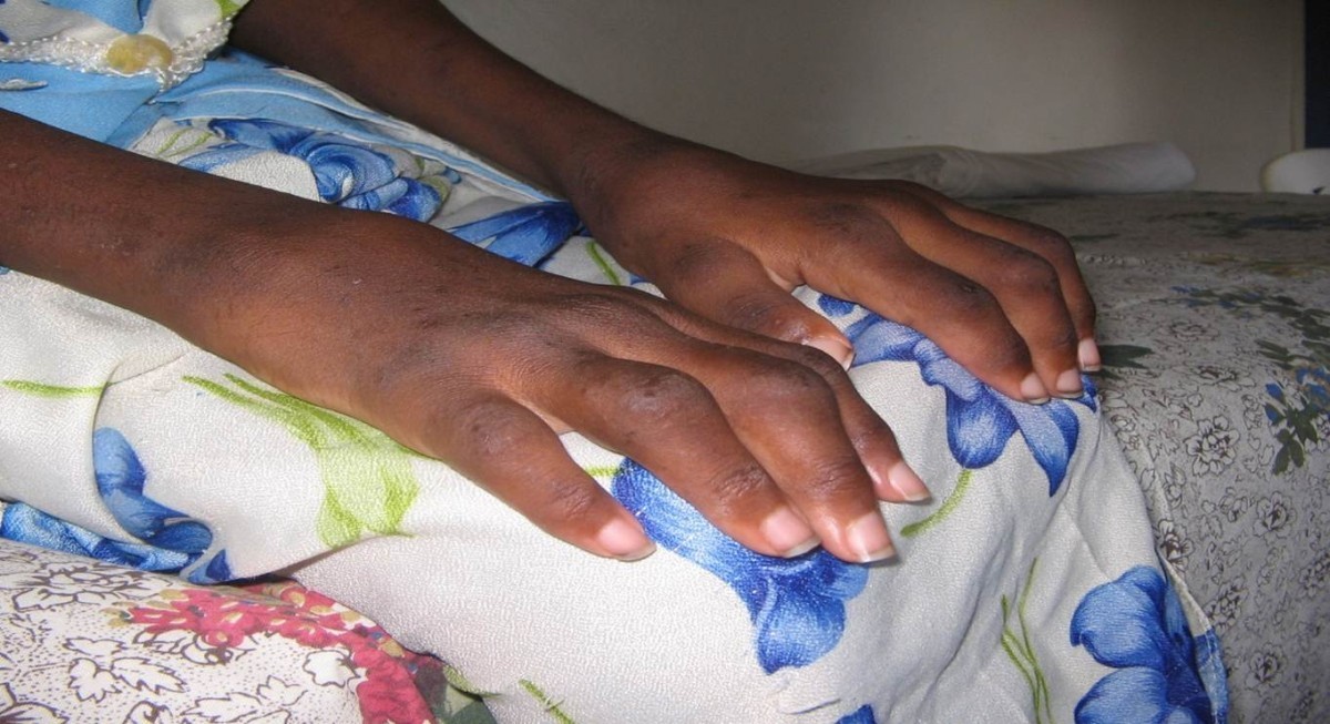 Clinical patterns of juvenile idiopathic arthritis in Zambia