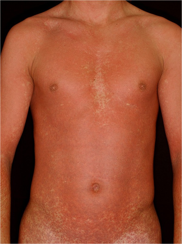 Amoxicillin rash in patients with infectious mononucleosis