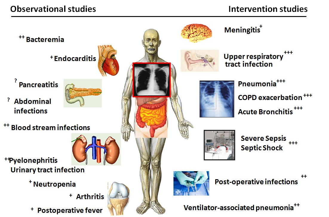 Procalcitonin for diagnosis of infection and guide to antibiotic