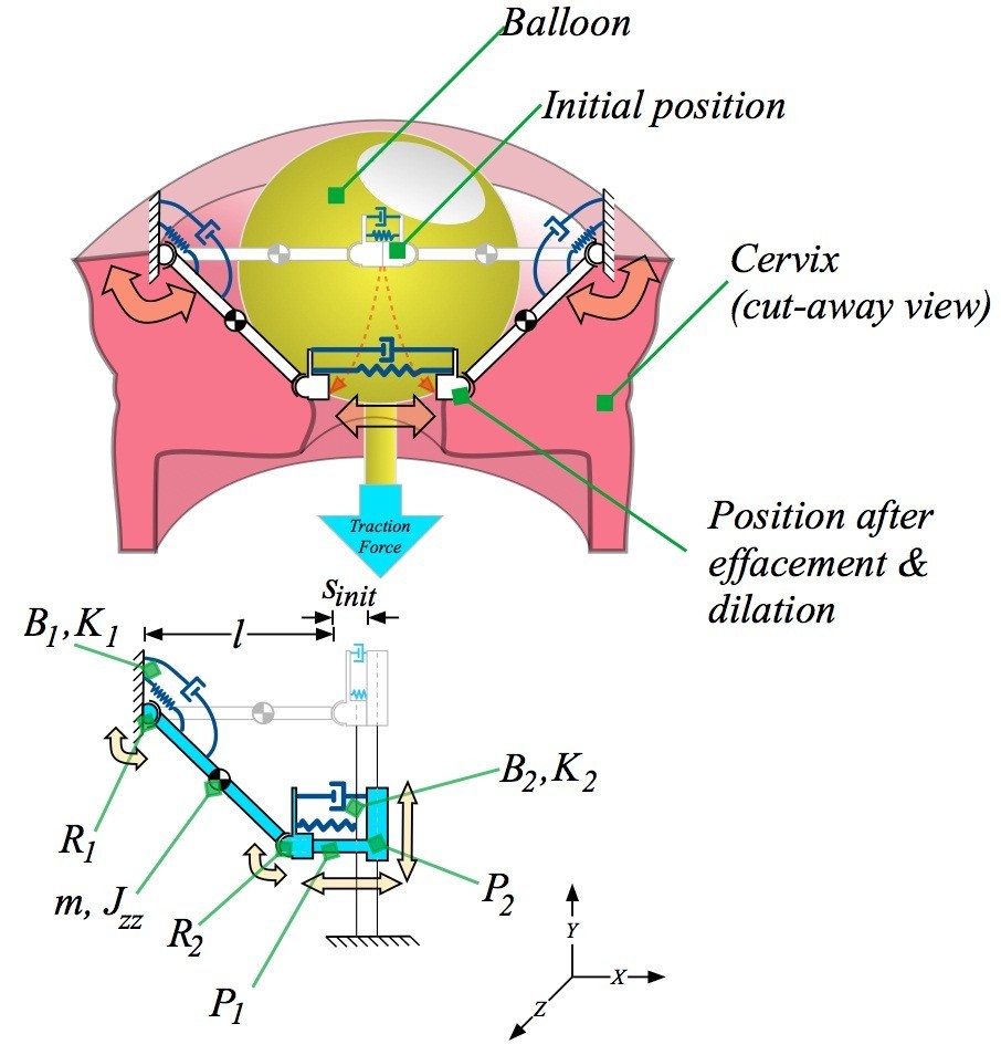 A simplified cervix model in response to induction balloon in pre