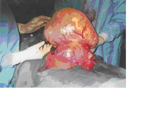 Successful myomectomy during pregnancy A case report Reproductive