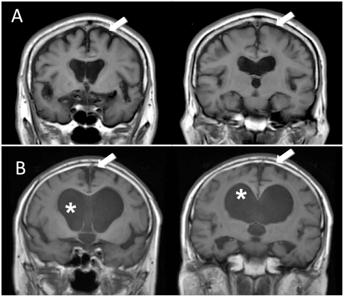 Diagnosis of idiopathic normal pressure hydrocephalus is ...