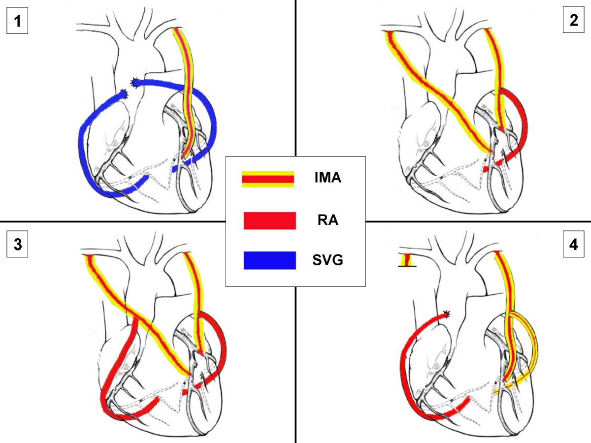 Free Free Svg Heart Artery 704 SVG PNG EPS DXF File