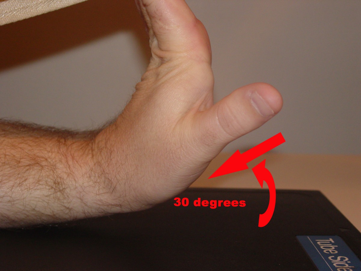 Case report of right hamate hook fracture in a patient with previous