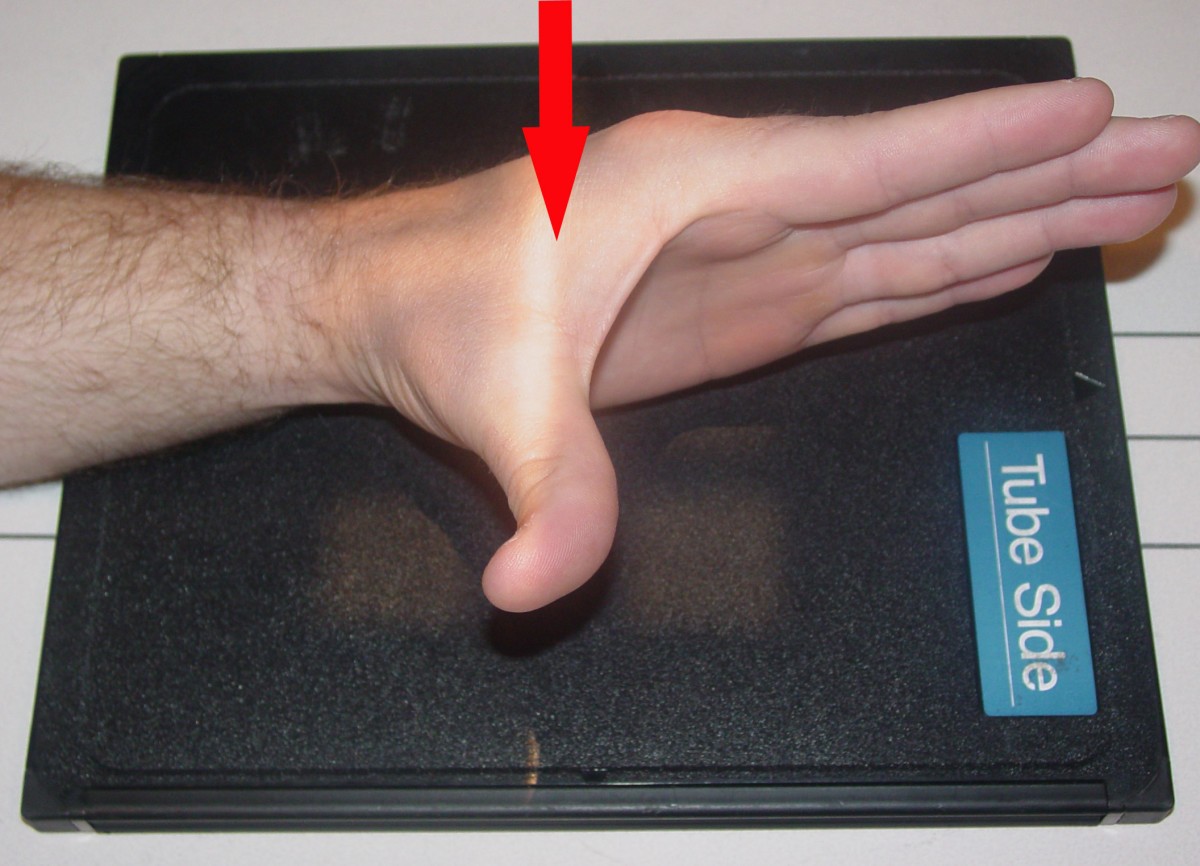 Case report of right hamate hook fracture in a patient with previous