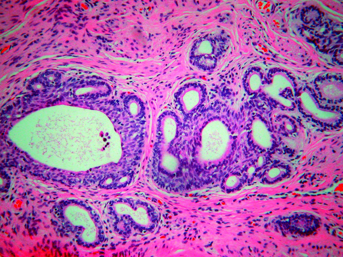 Adenoid basal carcinoma of the cervix in a 20yearold female a case