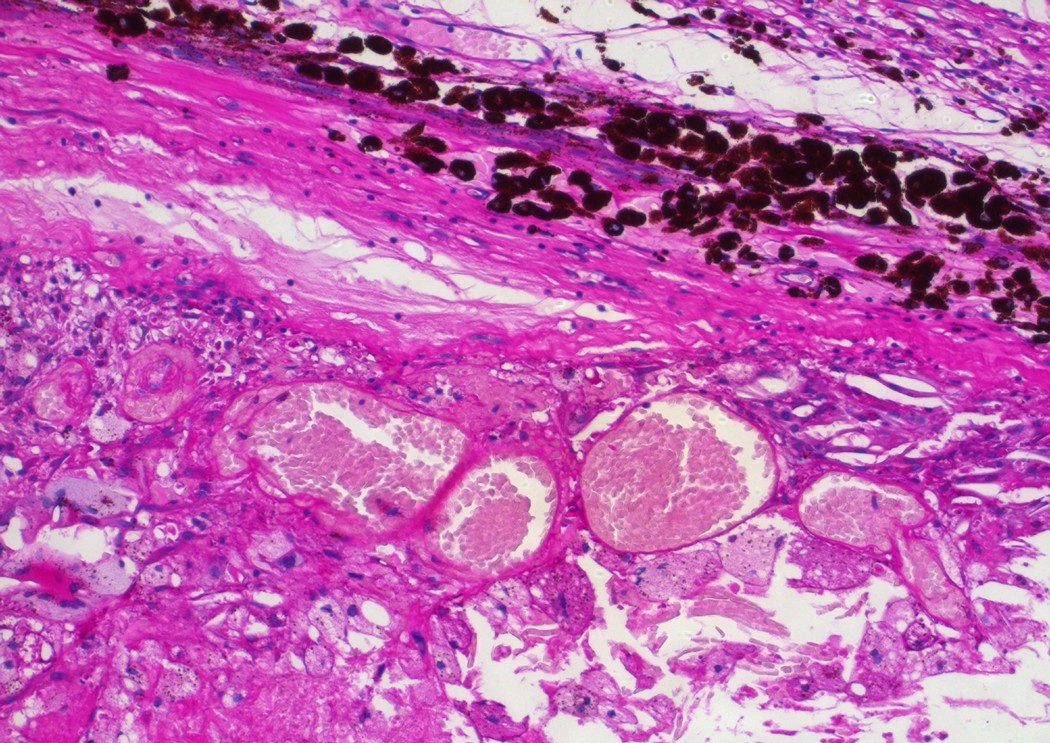 Clinicalhistopathological correlation in a case of Coats' disease