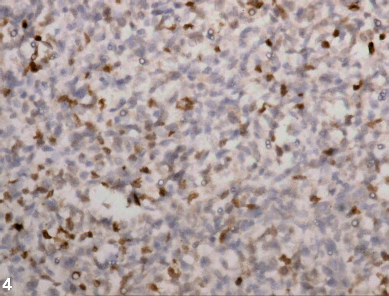 Postauricular congenital alveolar rhabdomyosarcoma- a case report of an