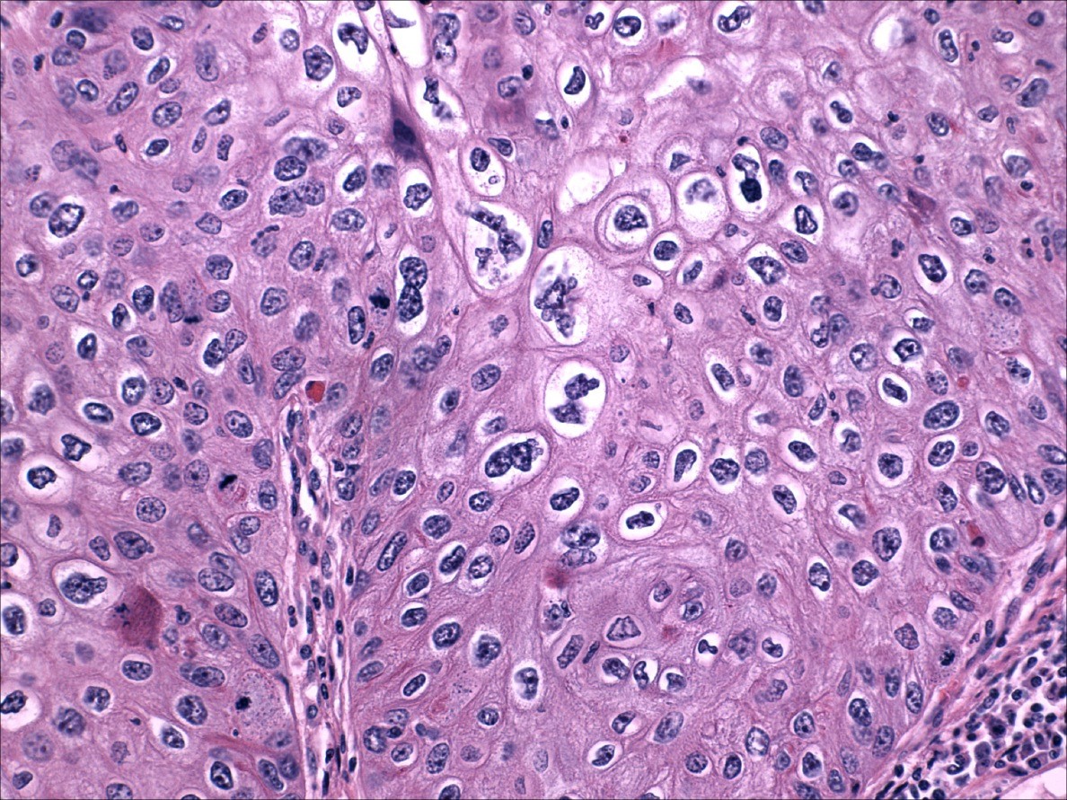 Dysplastic Ichthyosis Uterilike changes of the entire endometrium