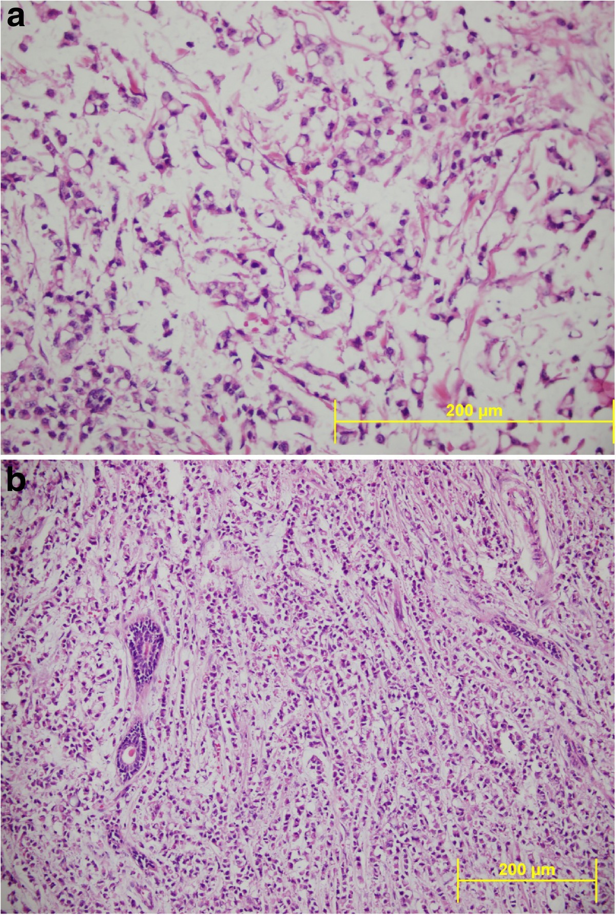 Invasive lobular carcinoma with extracellular mucin as a distinct