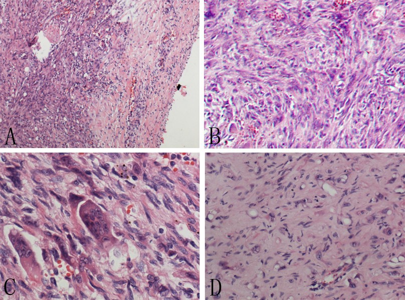 Mediastinal epithelioid hemangioendothelioma with abundant spindle