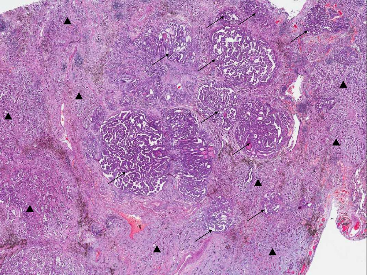 Pulmonary metastasis of a papillary thyroid carcinoma and