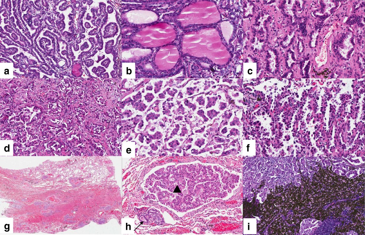 Pulmonary metastasis of a papillary thyroid carcinoma and ...