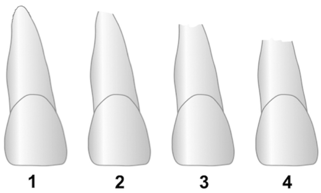 Root resorption, treatment time and extraction rate during orthodontic