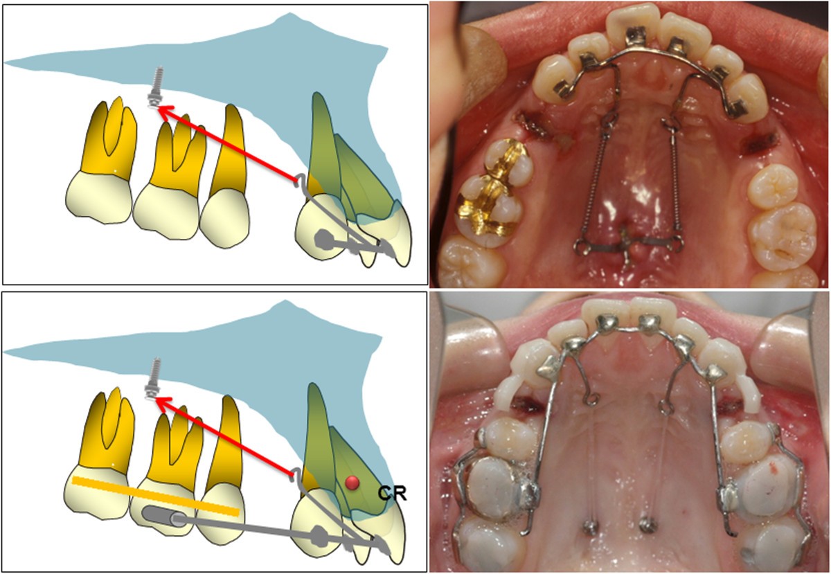 Anteroposterior lingual sliding retraction system for orthodontic correction of hyperdivergent