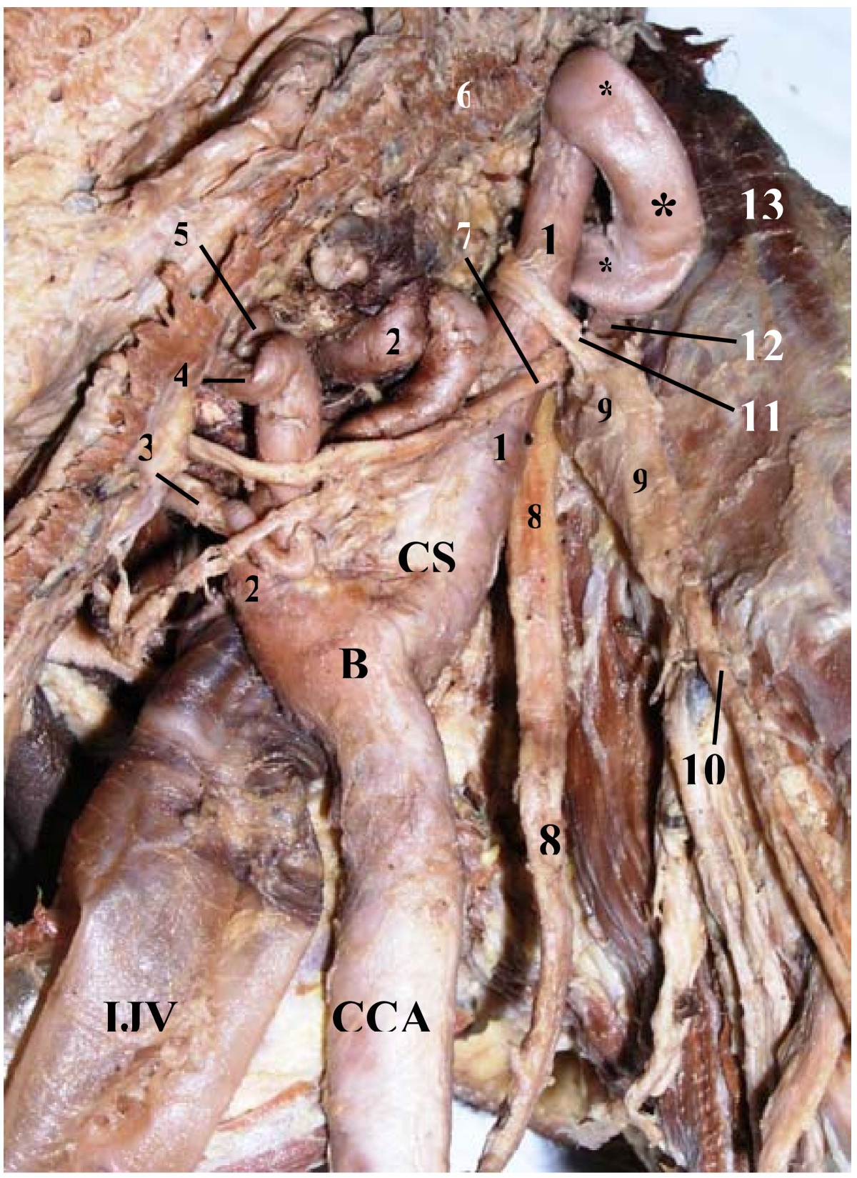 Unilateral congenital elongation of the cervical part of the internal