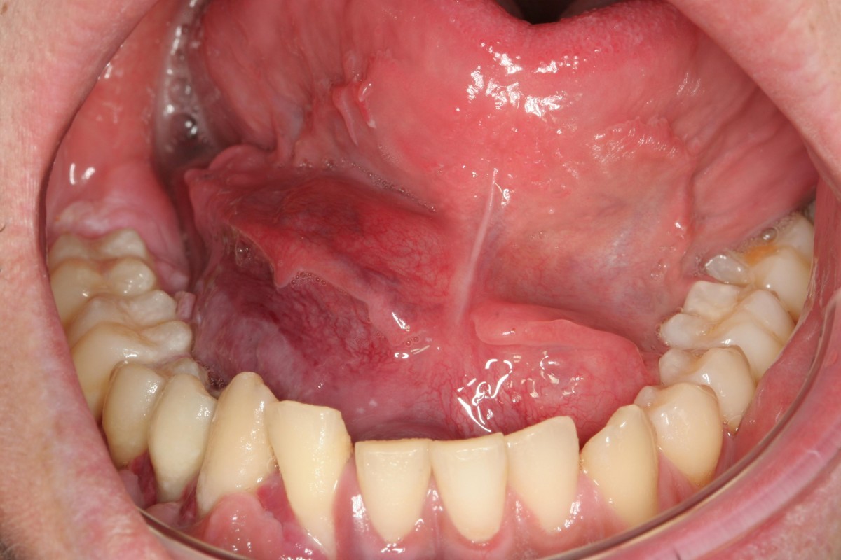 Ewing of the mandible mimicking an odontogenic abscess a case report Head & Face