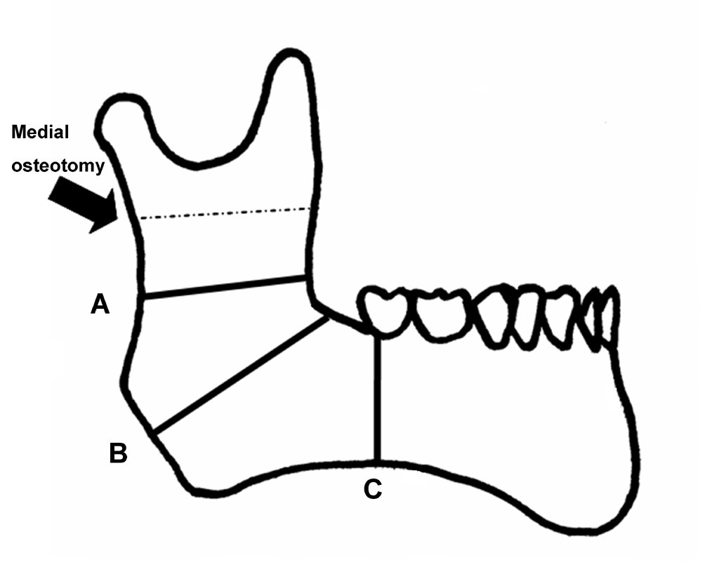 Three lateral osteotomy designs for bilateral sagittal split osteotomy