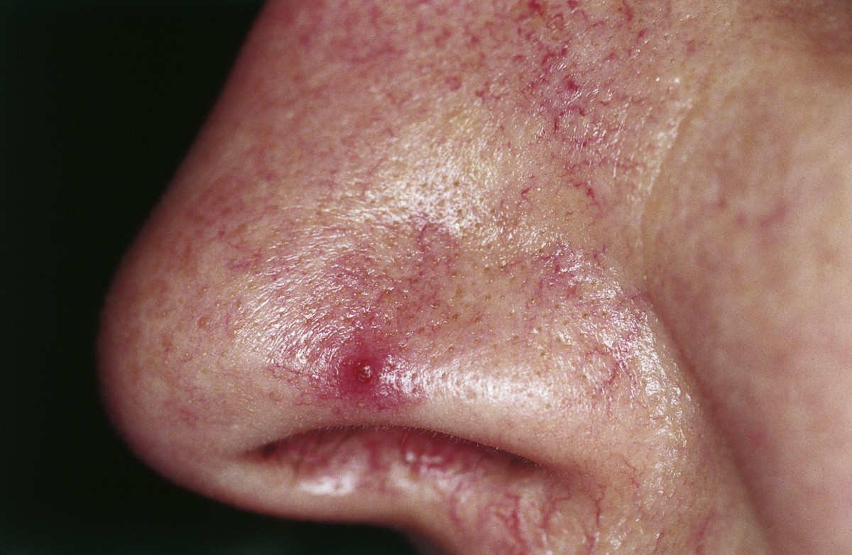cutaneous-lesions-of-the-nose-head-face-medicine-full-text