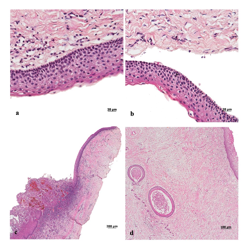 Early diagnosis of Gorlin-Goltz syndrome: case report | Head & Face ...
