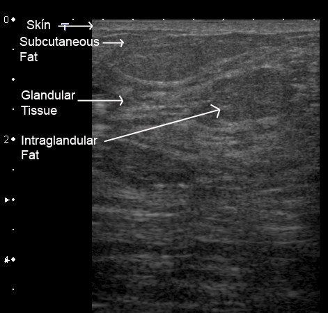 Ultrasound imaging of the lactating breast: methodology and application ...