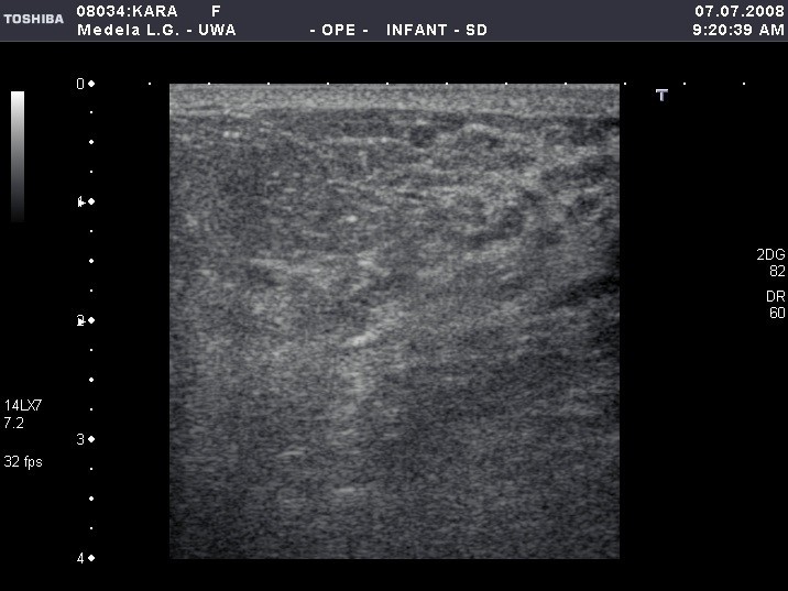 Ultrasound imaging of the lactating breast methodology and application