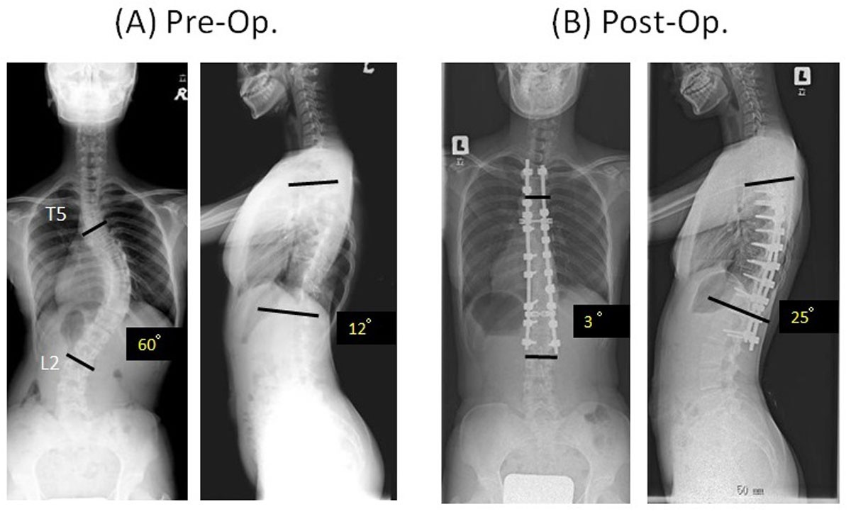 A new corrective technique for adolescent idiopathic scoliosis convex