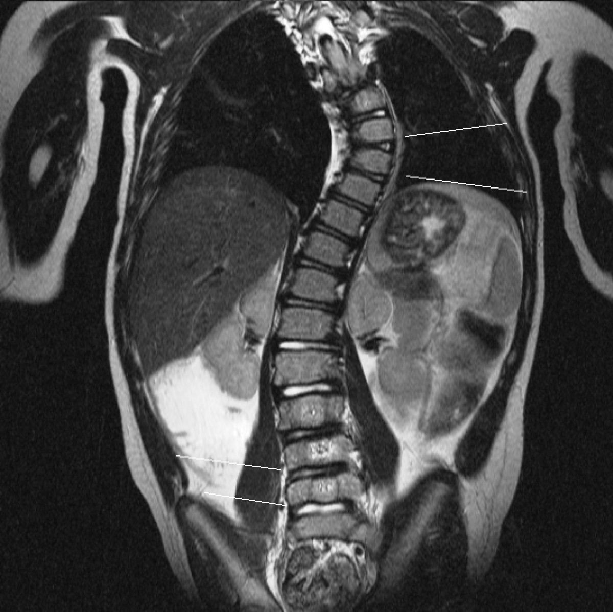 The vertebral body growth plate in scoliosis a primary disturbance of