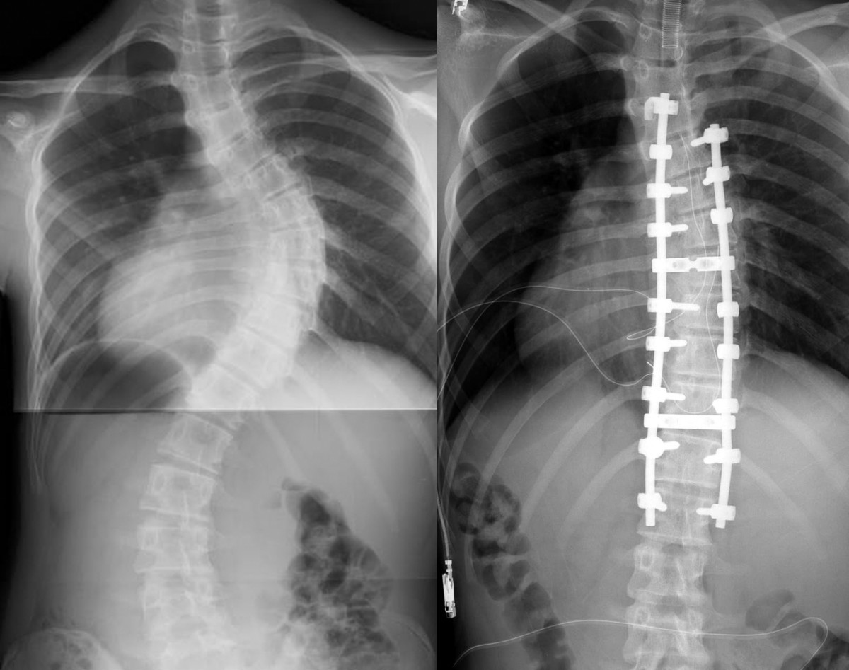 Surgical treatment of scoliosis a review of techniques