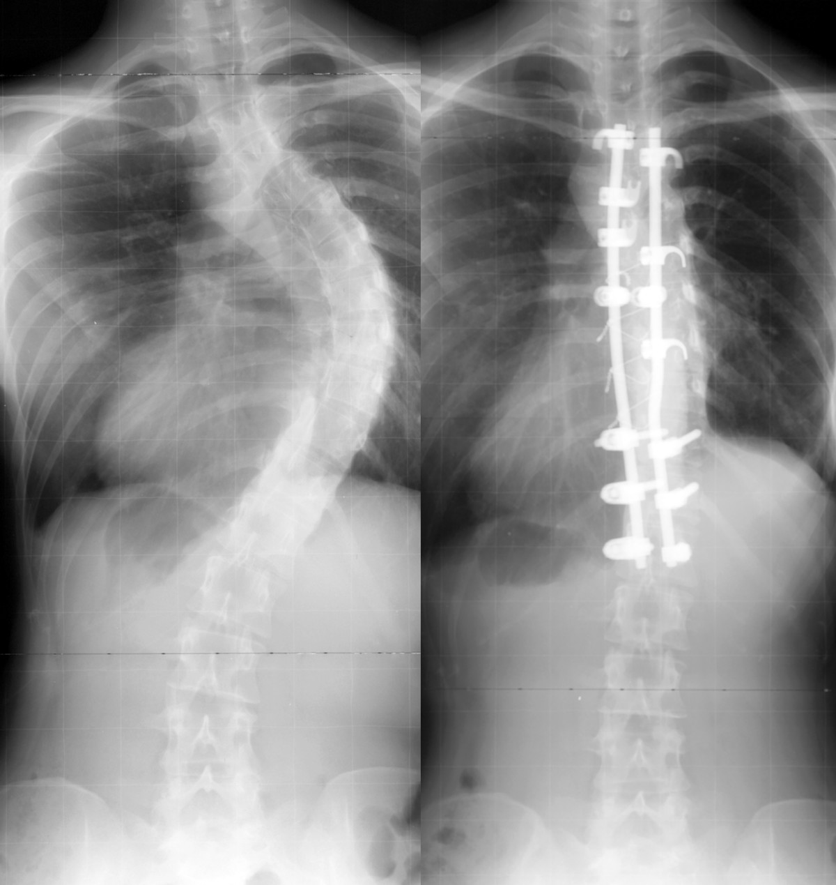 Surgical treatment of scoliosis a review of techniques