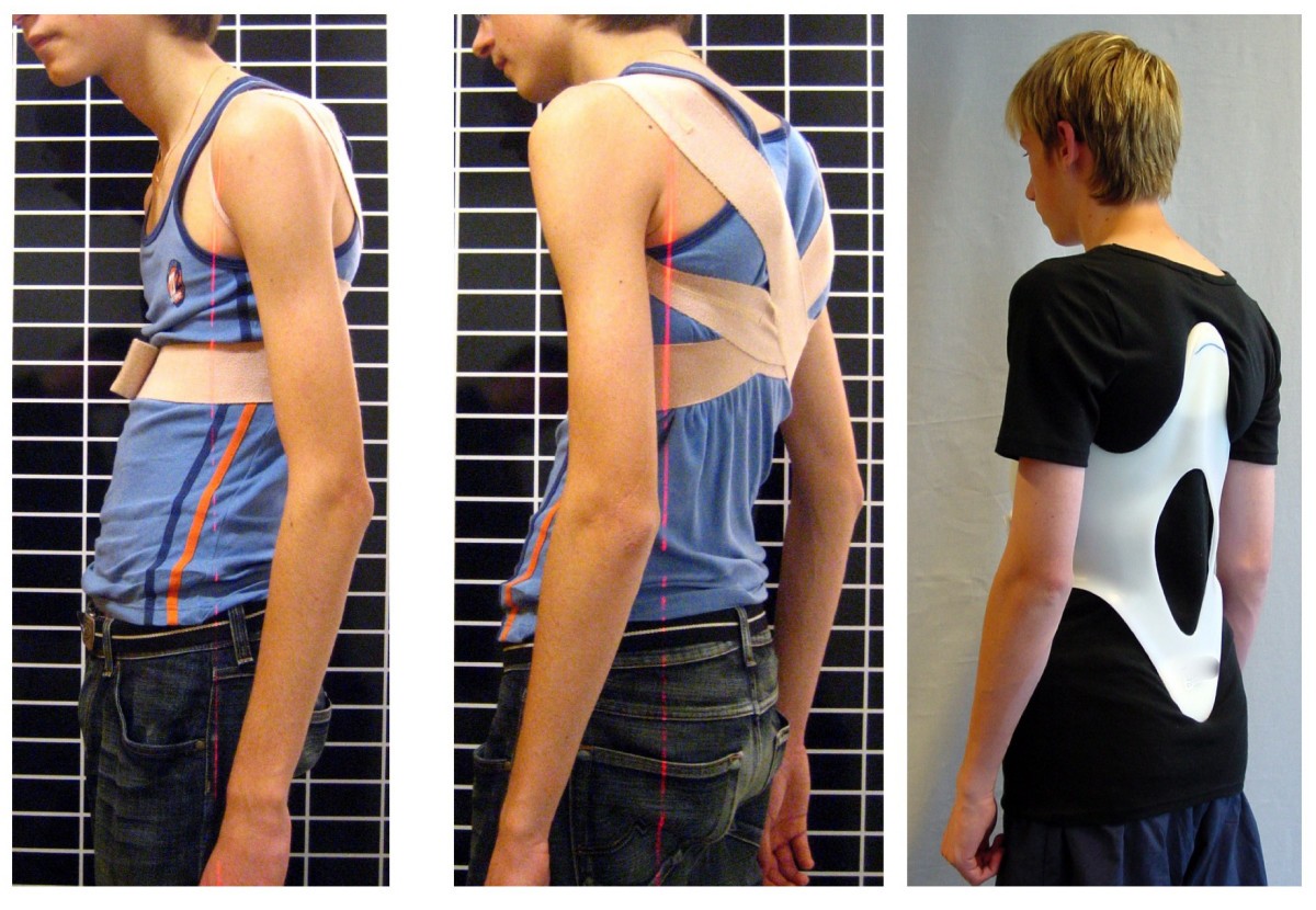 Brace treatment for patients with Scheuermann's disease a review of